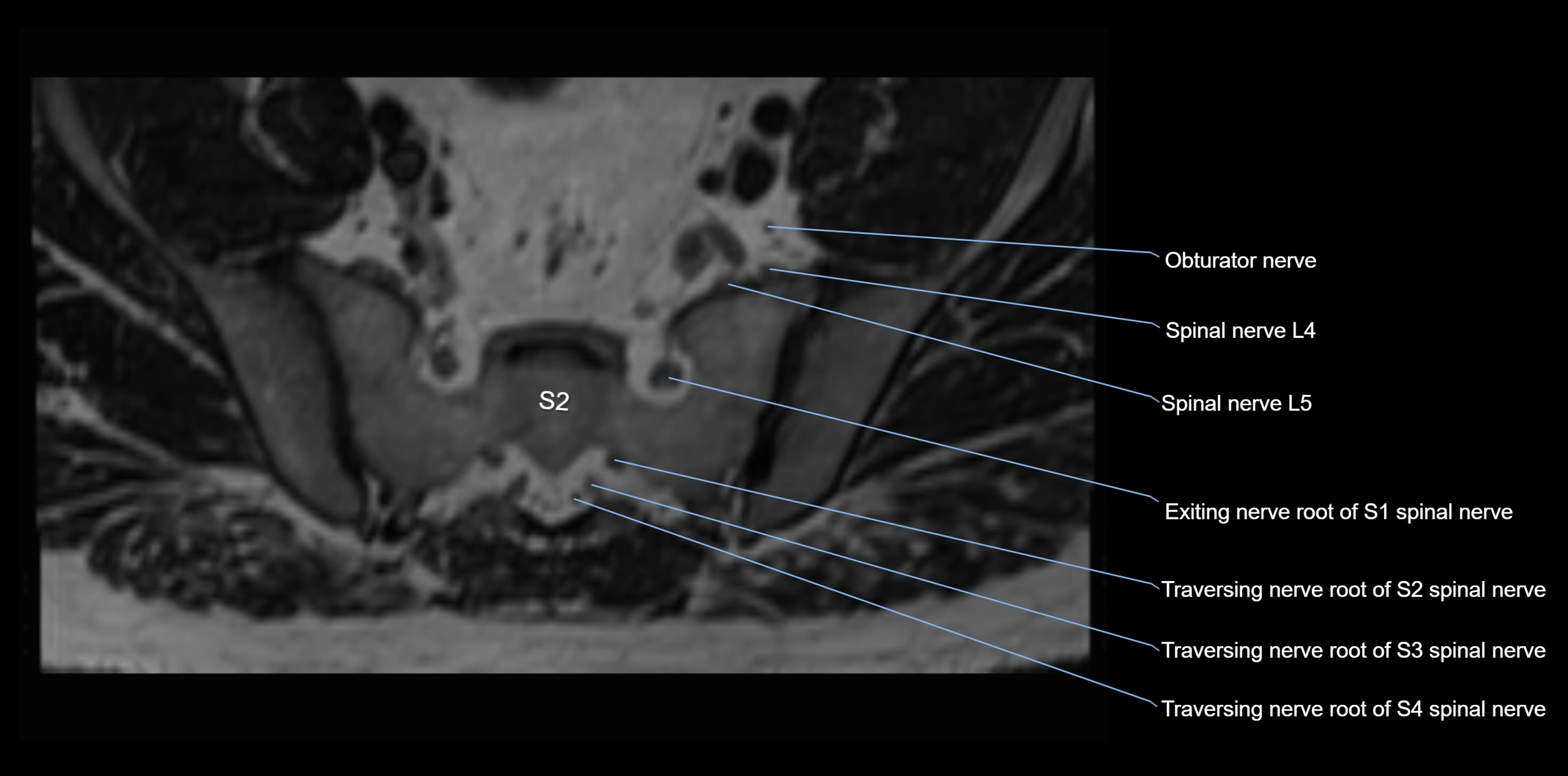 MR lumbosacral plexus axial cross sectional anatomy 3T  radiology  image-img-1008001-00081.webp